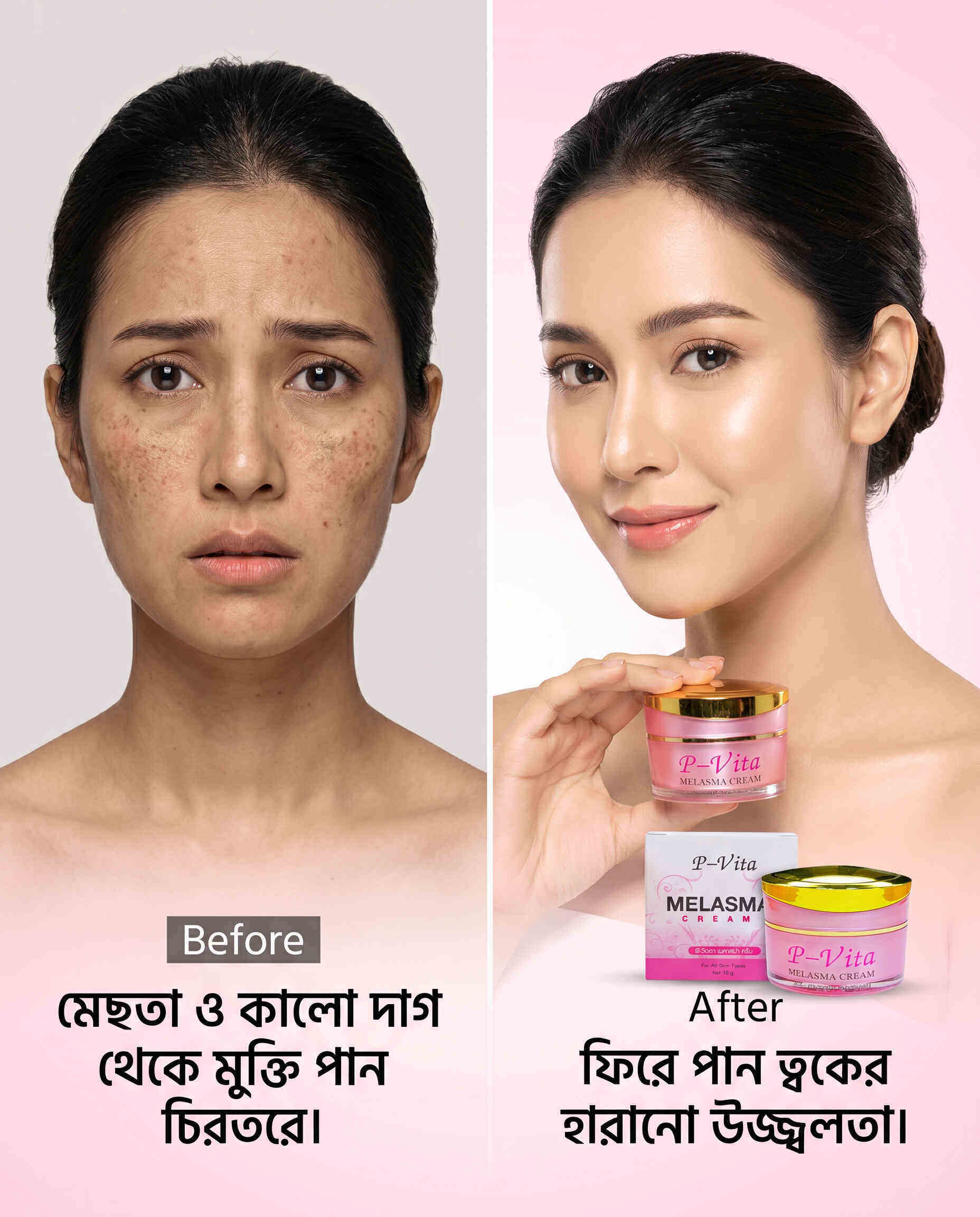 P-Vita Melasma Cream